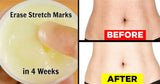 Stretchmark & Scar Treatment cream